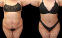 Mommy makeover before-and-after photos depicting results of combined 360 liposuction and tummy tuck. Note particularly how flank liposuction and tightening resulting in restoring a curvier silhouette and a natural-looking figure. Both the abdomen and flanks were tightened and smoothed for a youthful contour from every angle.
