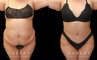 Mommy makeover before-and-after photos depicting results of combined 360 liposuction and tummy tuck. Note particularly how flank liposuction and tightening resulting in restoring a curvier silhouette and a natural-looking figure. Both the abdomen and flanks were tightened and smoothed for a youthful contour from every angle.