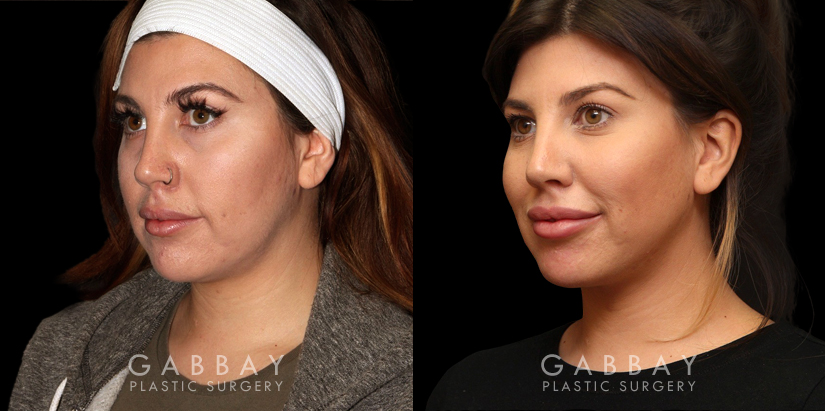 Procedures Depicted:  Buccal Fat Pad Removal