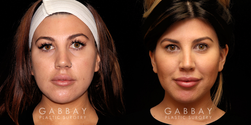 Procedures Depicted:  Buccal Fat Pad Removal