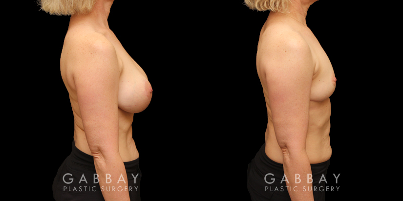 Procedures Depicted:  Auto Augmentation with mesh