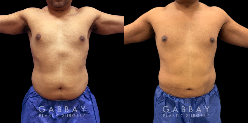 Patient 02 3/4th Right Side View Lipo Elite PT Gabbay Plastic Surgery