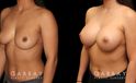 This is a breast augmentation patient who had significant asymmetry. She underwent silicone breast implant augmentation, using different sized high profile Allergan Natrelle Soft Touch implants: 365 cc on the left, 435 cc on the right. Implants were placed below the muscle in a dual plane configuration using an incision that is beautifully hidden within the breast fold.