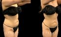 Patient with mild liposuction for the abdomen to help reduce some of the stubborn pockets of fat while also slimming the waist for a renewed youthful shape.