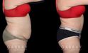 Patient before and after her tummy tuck procedure combined with liposuction around the waist. The final effect is slimming from multiple angles with no visible scarring. Note the smoother texture of skin and lending to a more youthful visual.