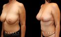 Procedures Depicted:  Breast lift and auto aug