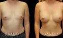 Patient results for breast augmentation with silicone implants. Before there was minimal breast volume, with the results increasing size without damaging the skin around the breasts. Note the lack of visible scarring.