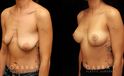 Procedures Depicted:  Breast Augmentation – Silicone & Lift