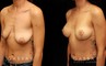 Procedures Depicted:  Breast Augmentation – Silicone & Lift