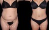 Photos of patient results after a combination of multiple liposuction procedures, each targeting a different area. Liposuction of the back bra roll, arms, and Buffalo hump augmented by abdominal tightening produced a flat, tighter torso from each angle.