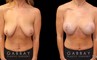 Patient 25 Front View Breast Augpexy Gabbay Plastic Surgery