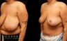 Patient 02 Right Side View Breast Reduction with Lift Gabbay Plastic Surgery