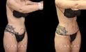 Younger female tummy tuck patient before and after her procedure. Abdominal tightening resulted in a flatter stomach while also eliminating the rolling effect of the skin while seated. Note the patient was able to maintain her natural curvy figure.