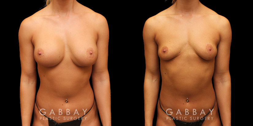 Procedures Depicted:  Implant revision-silicone