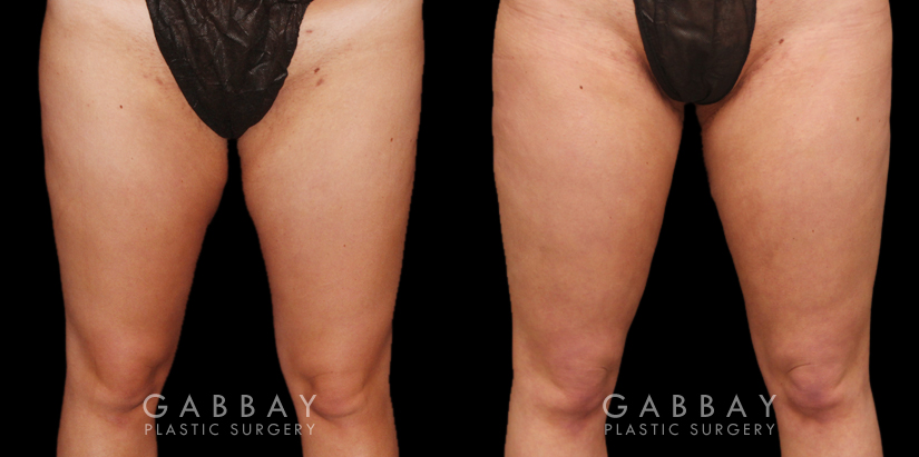Patient 04 Back View Thigh Lift Gabbay Plastic Surgery