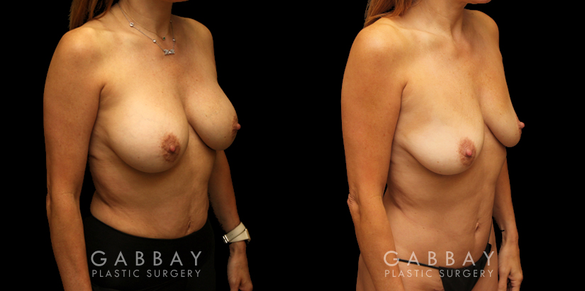 Procedures Depicted:  Mini tummy tuck and lipo to waist