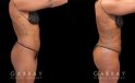 Multiple views of African-American female patient before and after combined liposuction and 360 lipo. Patient’s waist has notable slimming and contouring that enhances the fullness of the buttock. With the butt lift injections, the top position of the butt appears higher, resulting in a rounder curve with a more pronounced gluteal shape.