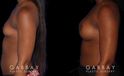 Patient results following recovery of breast augmentation using silicone implants. Note the increase in sense of fullness despite only boosting volume a restrained amount.