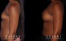 Patient results following recovery of breast augmentation using silicone implants. Note the increase in sense of fullness despite only boosting volume a restrained amount.