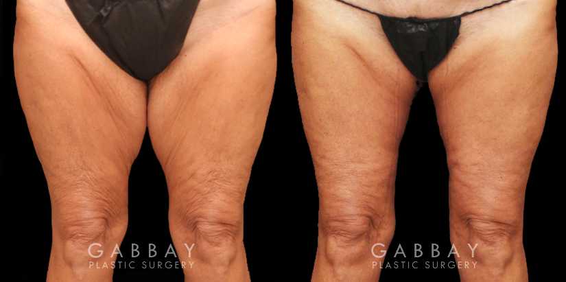 Patient 02 Back View Thighplasty and Knee Liposuction Gabbay Plastic Surgery