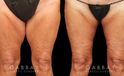 Patient 02 Back View Thighplasty and Knee Liposuction Gabbay Plastic Surgery