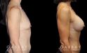 Breast augmentation results for patient with slim and fit body type. The silicone implants were chosen to match this tighter physique for a natural balance.