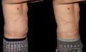 Male patients with liposuction results for full abdominal contouring. Patient healed well with minimal visible scarring and a flat stomach as seen in the profile view.