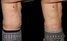Male patients with liposuction results for full abdominal contouring. Patient healed well with minimal visible scarring and a flat stomach as seen in the profile view.