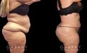 Tummy tuck patient results after abdominal tightening and liposuction to remove loose skin and stubborn pockets of fat. Note the complete tightening of back rolls, resulting in a smoother profile.