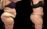 Tummy tuck patient results after abdominal tightening and liposuction to remove loose skin and stubborn pockets of fat. Note the complete tightening of back rolls, resulting in a smoother profile.