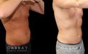 Male liposuction results before and after the procedure, showing the tighter abdomen. Note the significant improvement shown when sitting, showcasing the reduced belly fat from lipo.