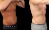 Male liposuction results before and after the procedure, showing the tighter abdomen. Note the significant improvement shown when sitting, showcasing the reduced belly fat from lipo.