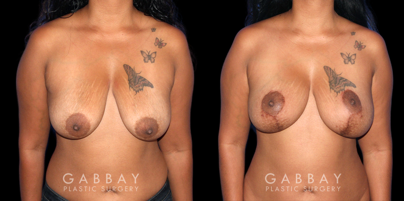 Procedures Depicted:  Wise Mastopexy with Silicone Breast Implants