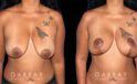 Procedures Depicted:  Wise Mastopexy with Silicone Breast Implants