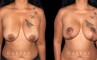 Procedures Depicted:  Wise Mastopexy with Silicone Breast Implants