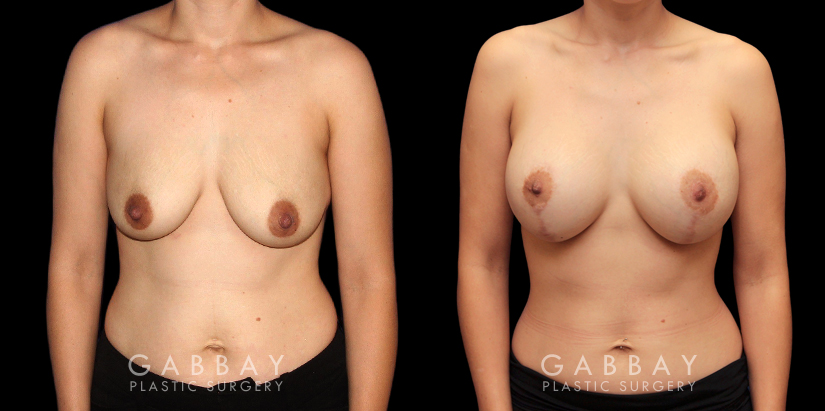 Procedures Depicted:  Scar Revision to Breasts