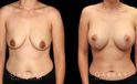 Procedures Depicted:  Scar Revision to Breasts