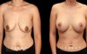 Procedures Depicted:  Scar Revision to Breasts