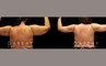 Procedures Depicted:  Arm lift with lipo