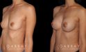 Patient result photos following silicone implant breast augmentation. Patient elected for a rounder shape with mild breast protrusion for subtle yet alluring results.
