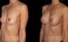 Patient result photos following silicone implant breast augmentation. Patient elected for a rounder shape with mild breast protrusion for subtle yet alluring results.