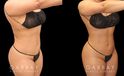 Patient was nearly at her ideal body appearance, but struggled with a few remaining pockets of fat. She underwent liposuction to remove the fat and saw impressive results that bring out her natural body features with a smoother torso in front and back.