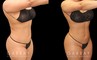 Patient was nearly at her ideal body appearance, but struggled with a few remaining pockets of fat. She underwent liposuction to remove the fat and saw impressive results that bring out her natural body features with a smoother torso in front and back.