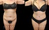 Patient results following her tummy tuck procedure with Dr. Gabby in Beverly Hills. Loose skin and pockets of fat were removed to create a natural-looking slimmer figure.