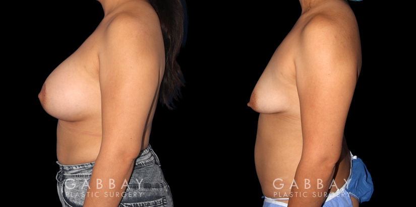 Procedures Depicted:  Breast Augmentation – Silicone & Lift