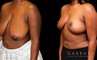 Procedures Depicted:  Breast reduction with lift
