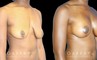 Silicone breast augmentation before-and-after photos demonstration enhanced breast size. Patient combined augmentation with a breast lift for improved breast position as well.