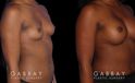 Patient results following recovery of breast augmentation using silicone implants. Note the increase in sense of fullness despite only boosting volume a restrained amount.