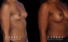 Patient results following recovery of breast augmentation using silicone implants. Note the increase in sense of fullness despite only boosting volume a restrained amount.