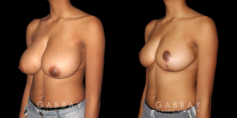 Procedures Depicted:  Breast Reduction